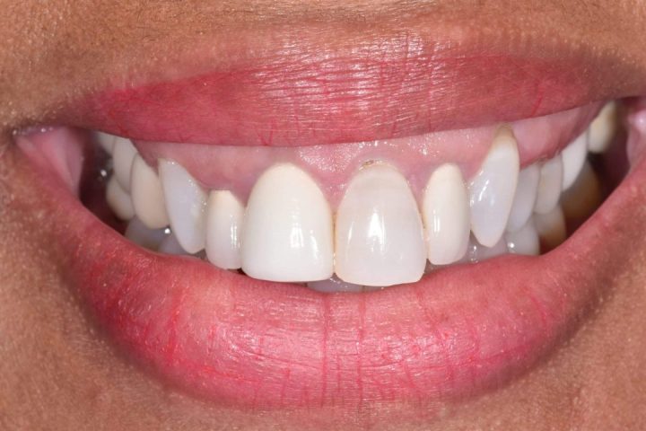 Cosmetic Dentistry Smile Transformation at Murphey Dental Aesthetics in Ridgeland, MS