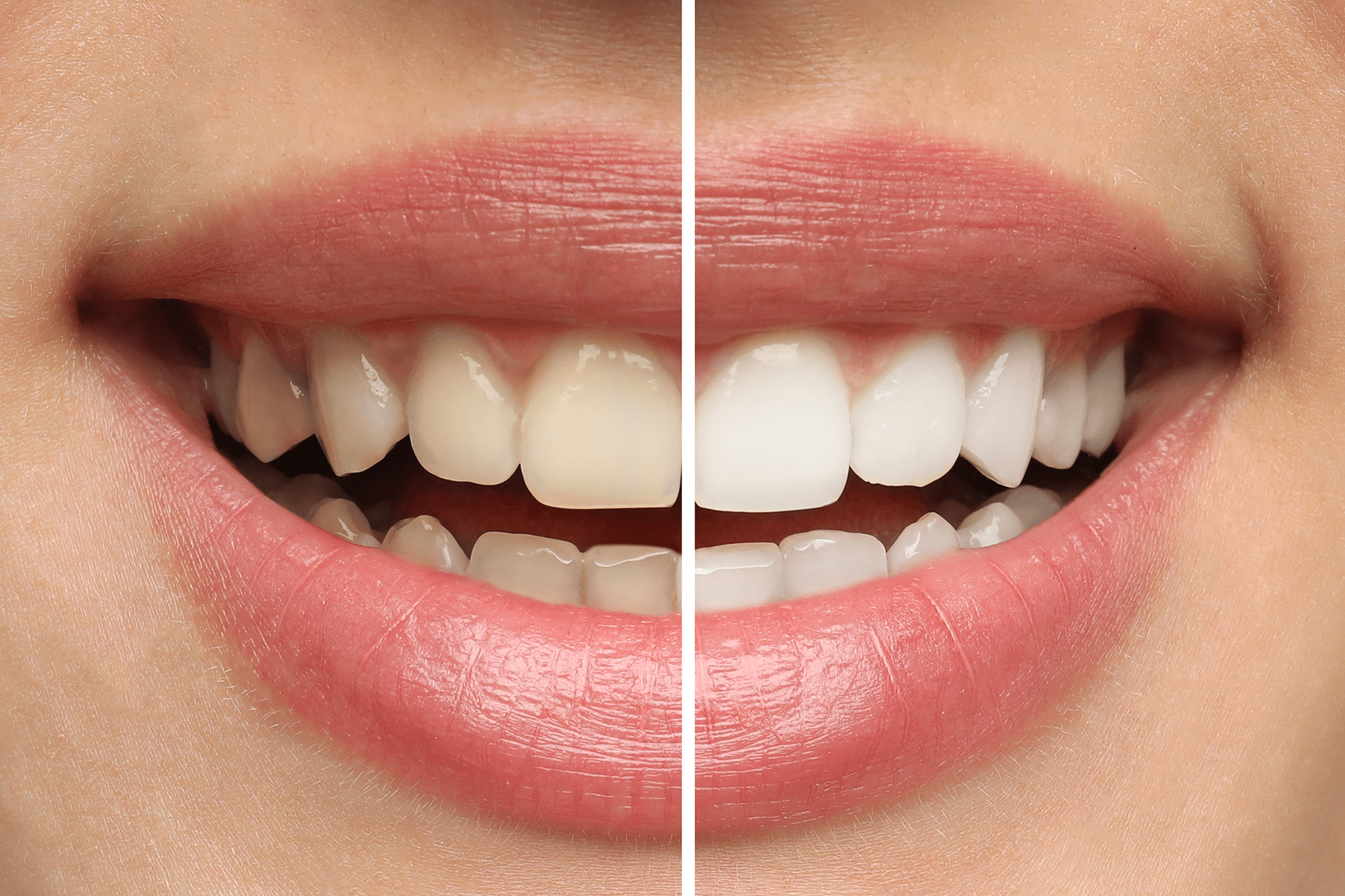 Results of Teeth whitening Treatment in Ridgeland MS