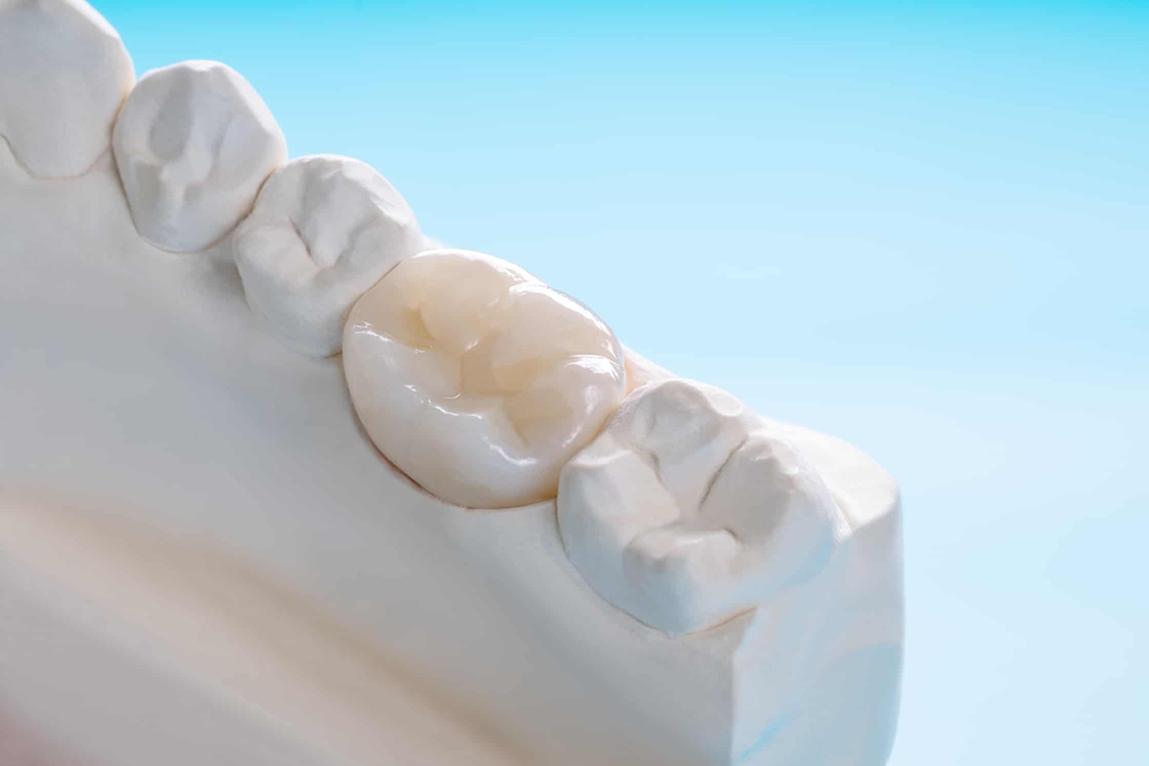 Restorative Dental Crowns available in Ridgeland, MS, at Murphey Dental Aesthetics